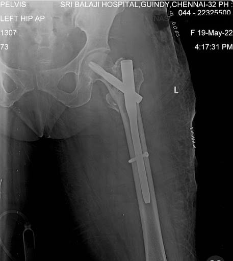 X-ray of the post keyhole fixation of the left hip for the patient.