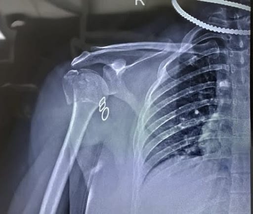 Pre-operative x-ray of a proximal Humerus shoulder fracture.