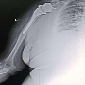 Post-operative X-ray of a severely damaged knee of an 81-year-old lady.
