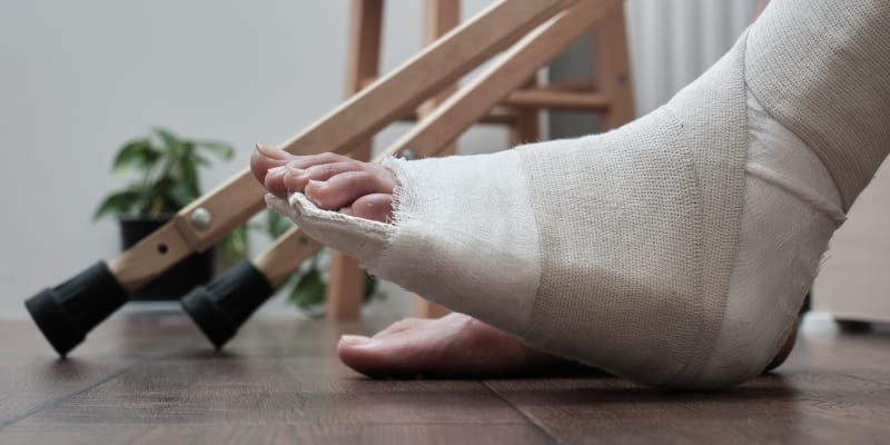 A close-up image of a patient with broken leg in a plaster cast illustrate the internal fixation for fractures.