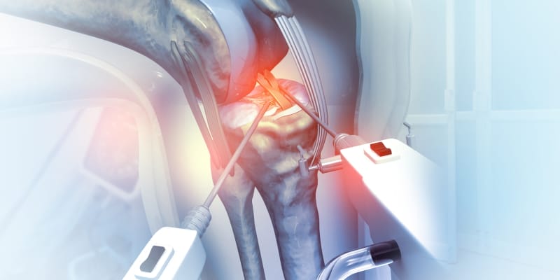 An illustration of robotic knee replacement for Arthritis.