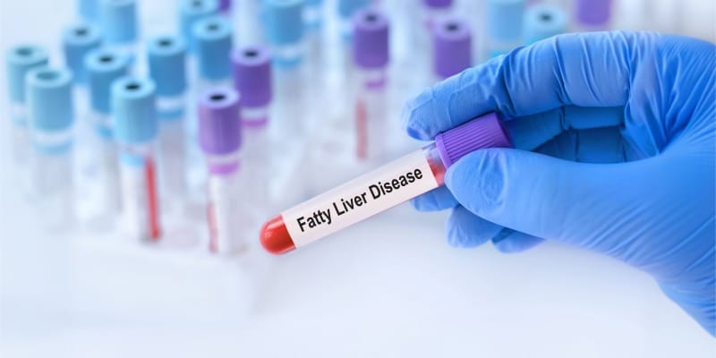 Doctor's gloved hand holding a blood test tube labeled Fatty Liver Disease, a key diagnostic step to understand what is fatty liver and how to reverse it.